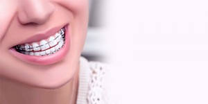 Dental Braces