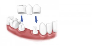 Dental Crown