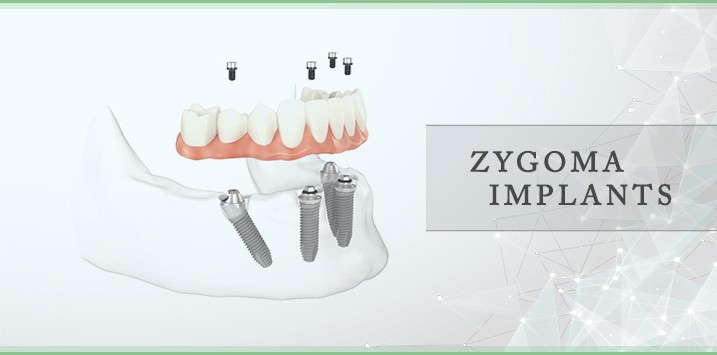 Zygoma Implants