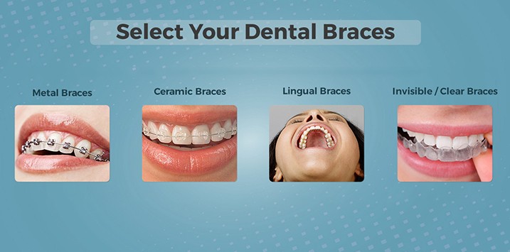 Types of Dental Braces