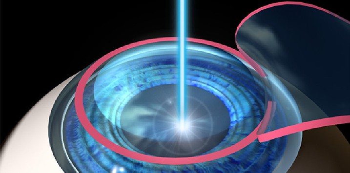 LASIK Surgery