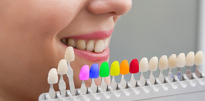 Tooth Coloured Fillings