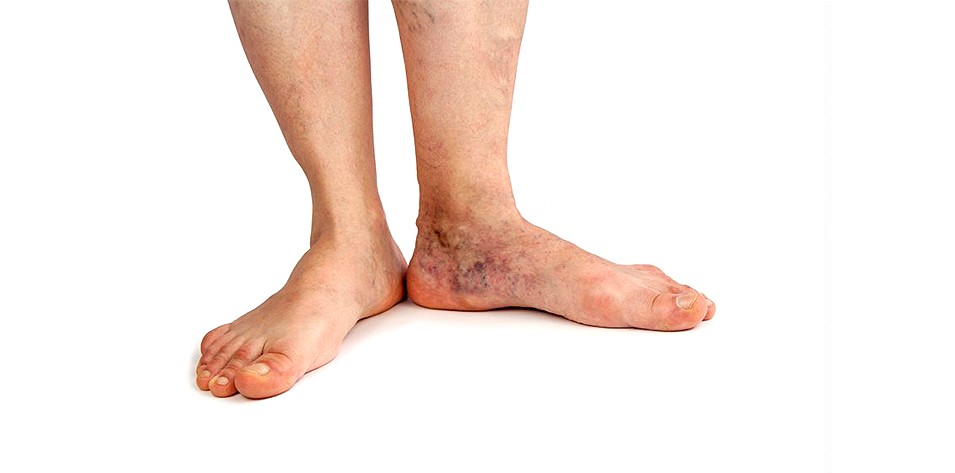 What Is Stasis Dermatitis?