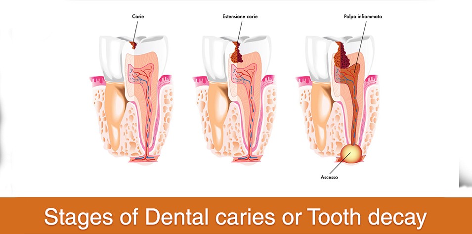 An Insight into Tooth Decay