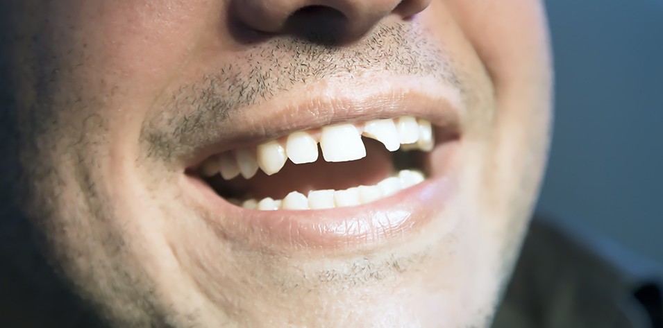 Chipped, cracked or gapped teeth - Perfect your imperfections!