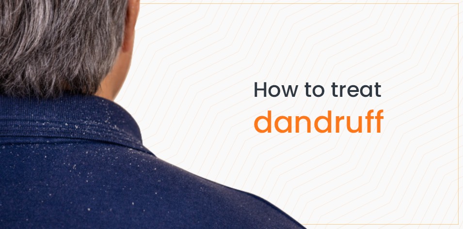 How to treat Dandruff