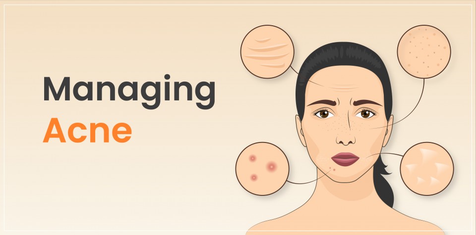 Managing Acne