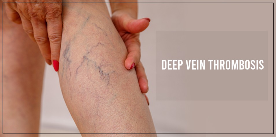 Deep Vein Thrombosis