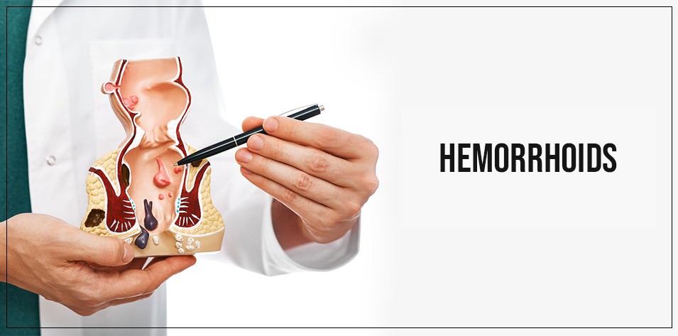 Hemorrhoids