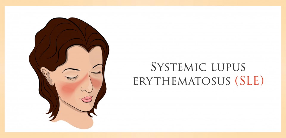 Systemic Lupus Erythematosus (SLE)