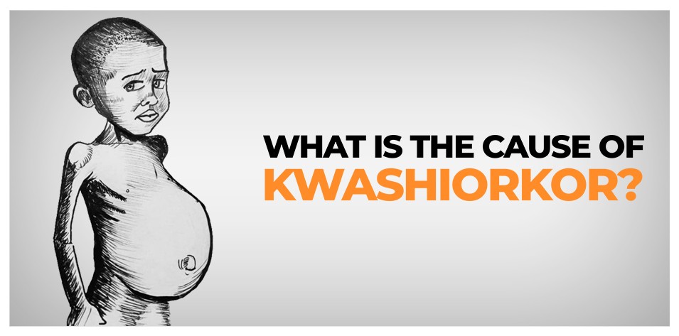 Kwashiorkor 