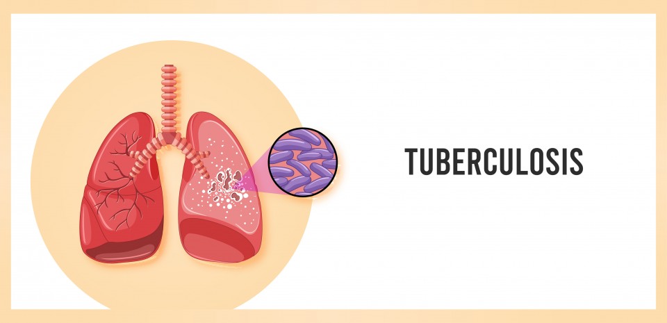 Tuberculosis 