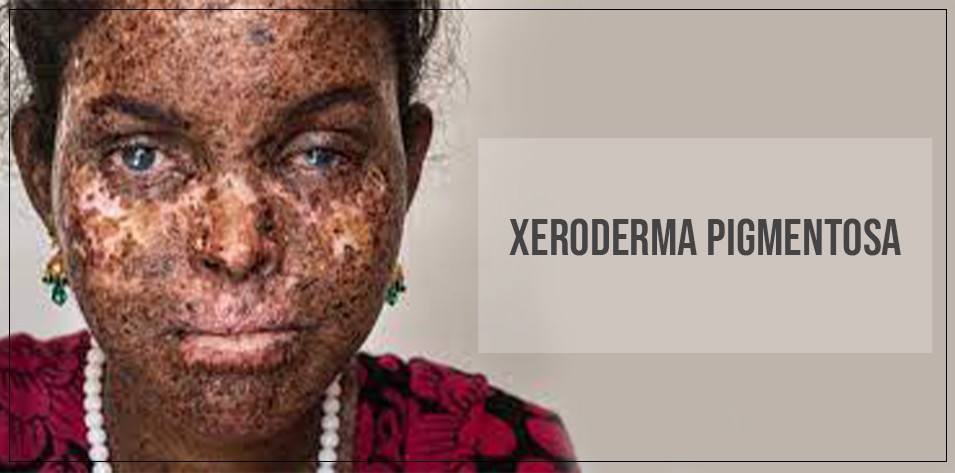 Xeroderma pigmentosum 