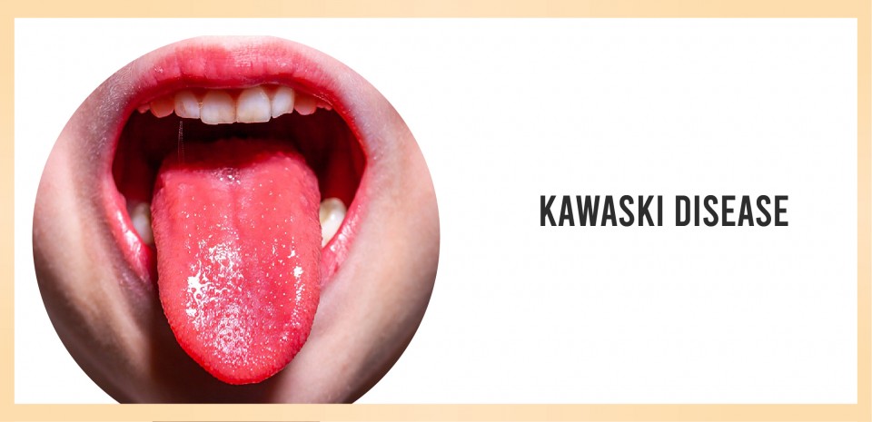 Kawasaki disease criteria