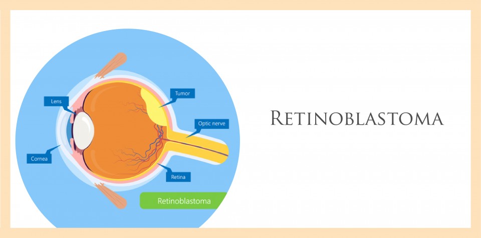 Retinoblastoma