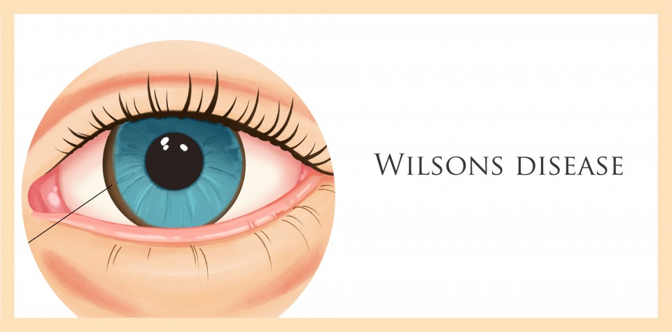 Wilsons Disease symptoms and treatment