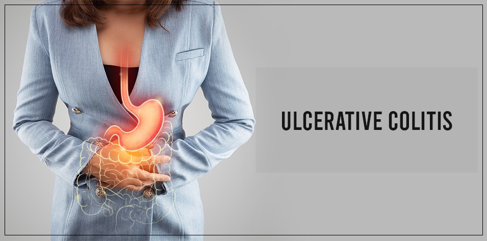 Will ulcerative colitis go away ?