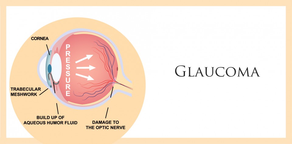 Can glaucoma be cured?