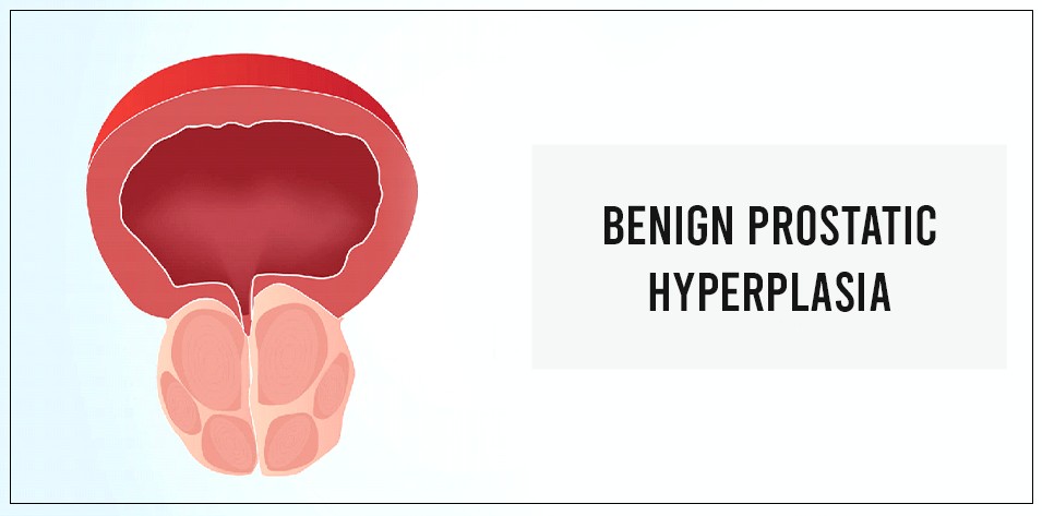Can benign prostatic hyperplasia be cured?