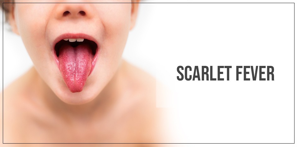 Which toxin causes scarlet fever?