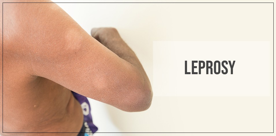 Why leprosy is referred to as living death?