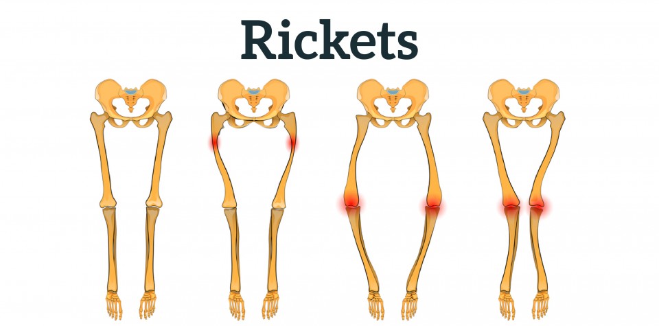 How rickets affect your life?
