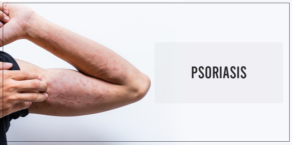 Psoriasis treatment