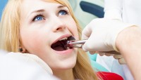 Teeth Extraction