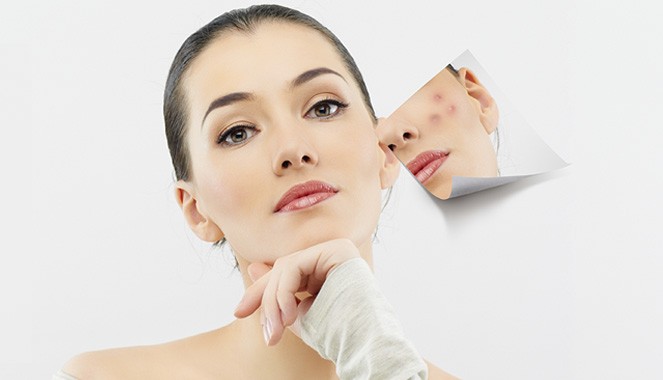 Chemical Peel