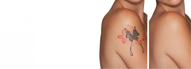 LASER Tattoo Removal