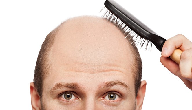 PRP for Hair Loss