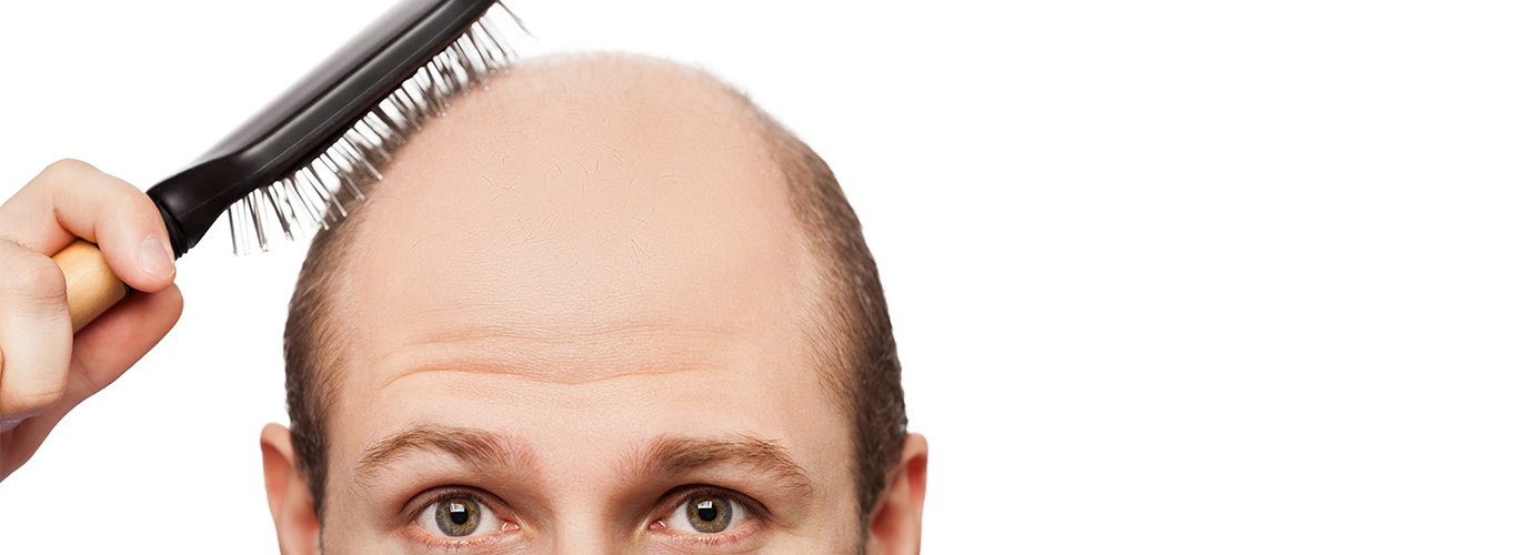 PRP for Hair Loss